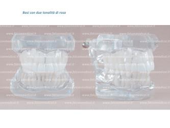 Real Series - Modello ortodontico, base rosa, Classe II, Divisione I