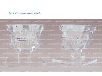 Real Series - Modello ortodontico da tavolo con brackets in ceramica e m